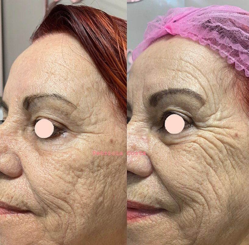 Revitalização Facial em Viamão – Dra. Patrícia Costa Biomédica