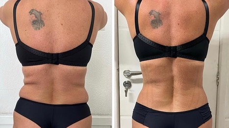 Shape By Fat em Viamão com Biomédica – Dra. Patrícia Costa