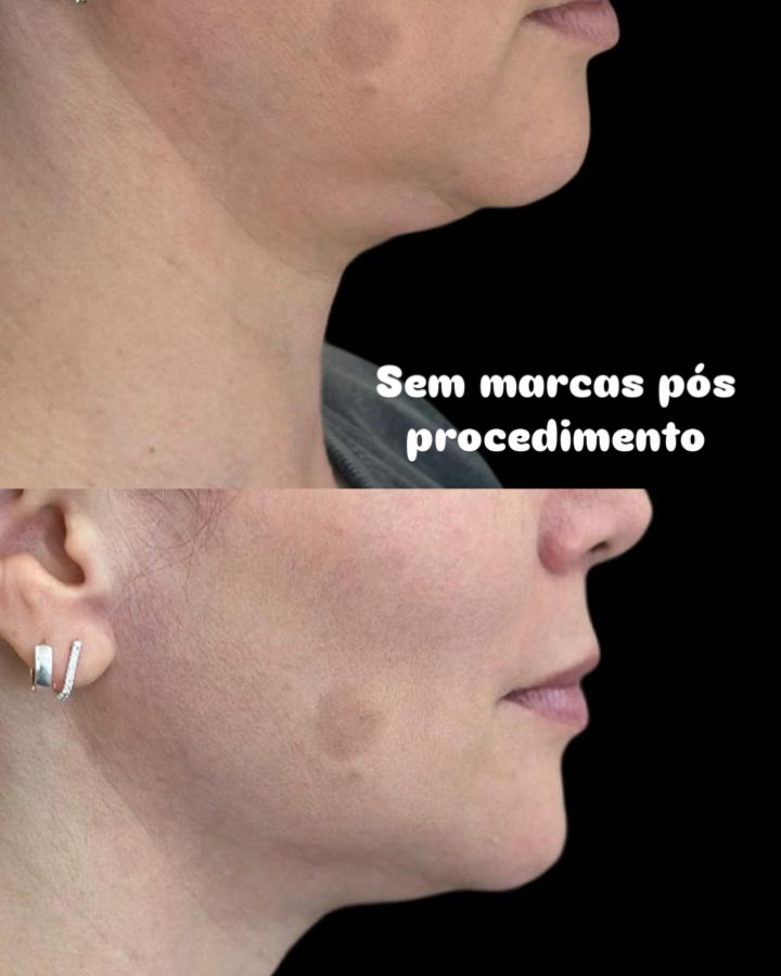 Perfiloplastia em Viamão com Dra. Patrícia Costa Biomédica