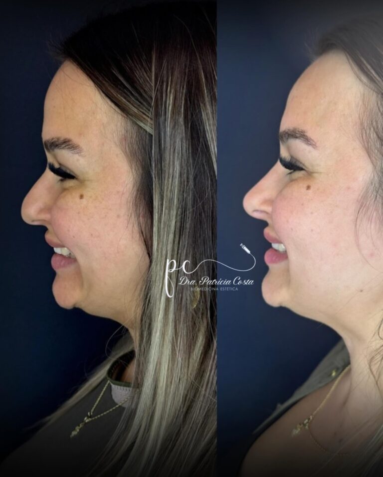 Perfiloplastia em Viamão com Dra. Patrícia Costa Biomédica