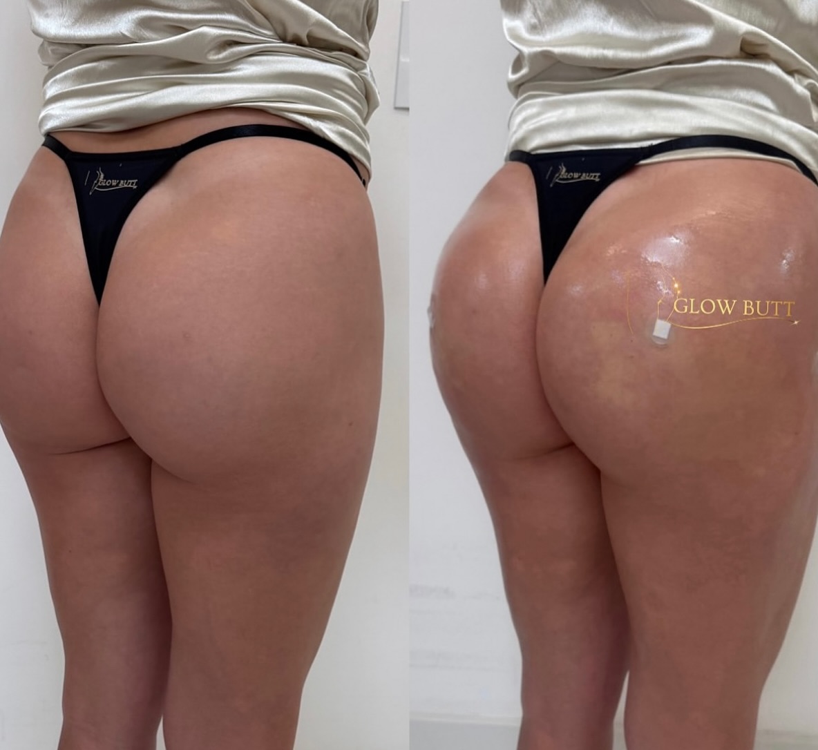 Harmonização de Glúteos em Viamão – Glow Butt com Dra. Patrícia Costa