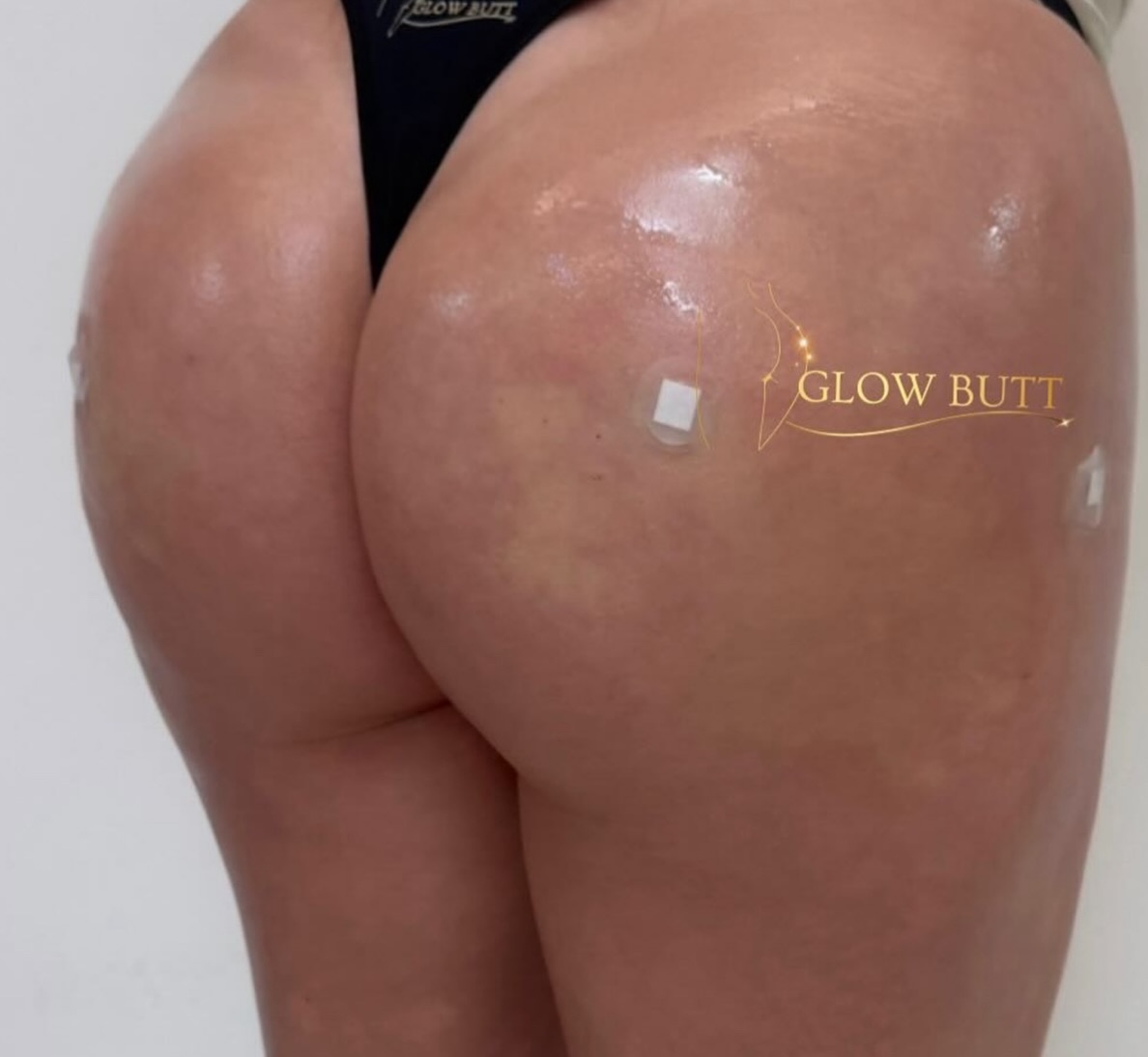 Harmonização de Glúteos em Viamão – Glow Butt com Dra. Patrícia Costa